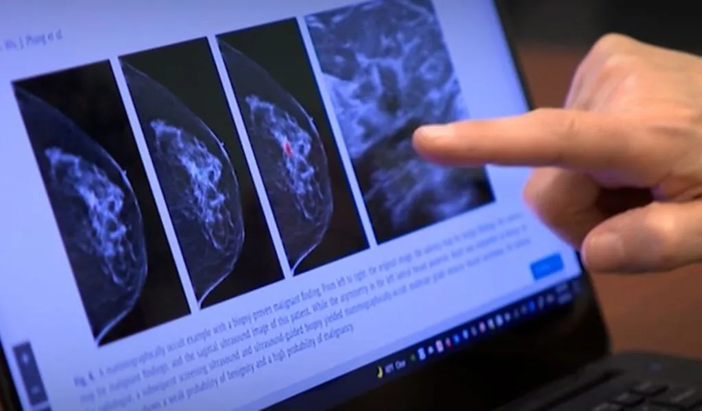 Breast Cancer Screening With AI Is As Good As 2 Radiologists