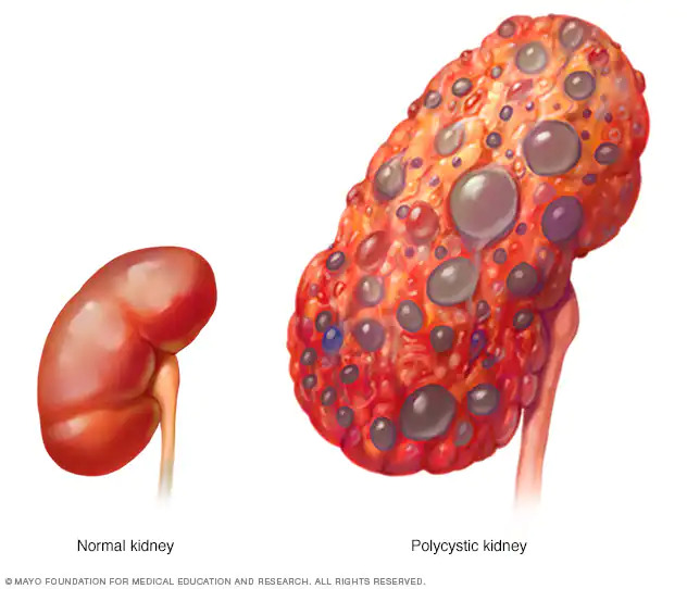 kidney damage1