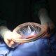 New Zealand Doctors Forget 9cm Surgical Ring Inside Woman