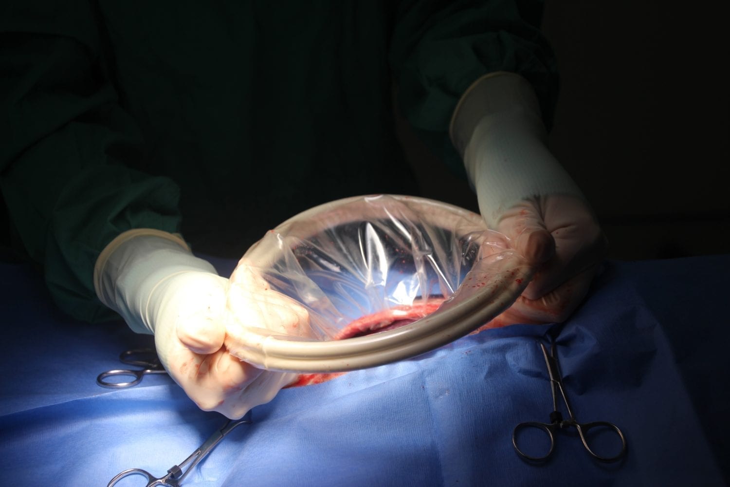 New Zealand Doctors Forget 9cm Surgical Ring Inside Woman