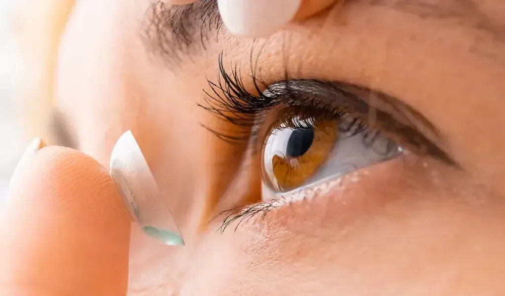 Contact Lenses Cause An Ulcer On a 25-Year-Old Woman's Cornea