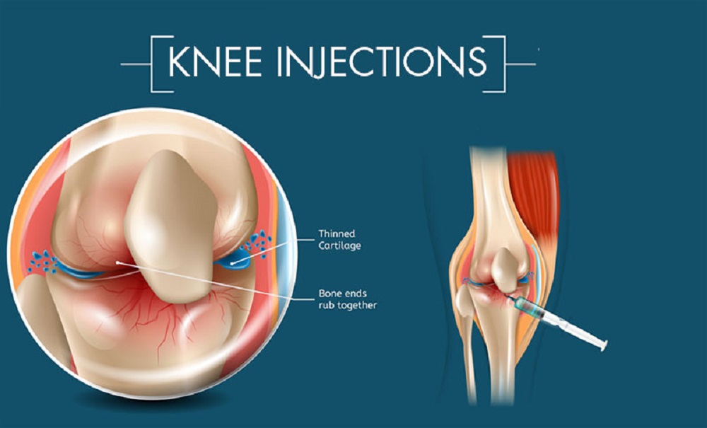 Hyaluronic Acid Injections knee