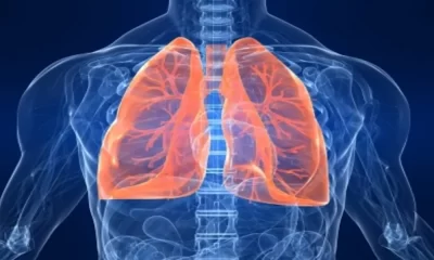 Women's Lung Cancer Risk May Be Boosted By Reproductive Factors