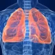 Women's Lung Cancer Risk May Be Boosted By Reproductive Factors