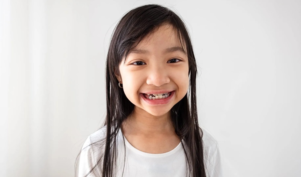 Dental Malocclusions in Children