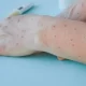 Thailand Monkeypox Outbreak