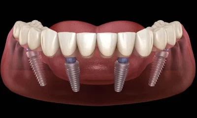 All on 4 Dental Implants - A Permanent Solution for Tooth Loss