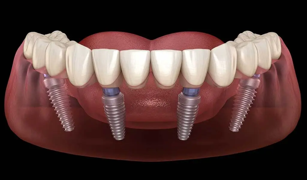All on 4 Dental Implants - A Permanent Solution for Tooth Loss