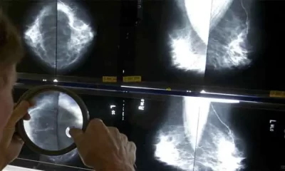 UK Study Suggests Breast Cancer Survivors May Need Fewer Mammograms Post-Surgery.