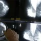 UK Study Suggests Breast Cancer Survivors May Need Fewer Mammograms Post-Surgery.