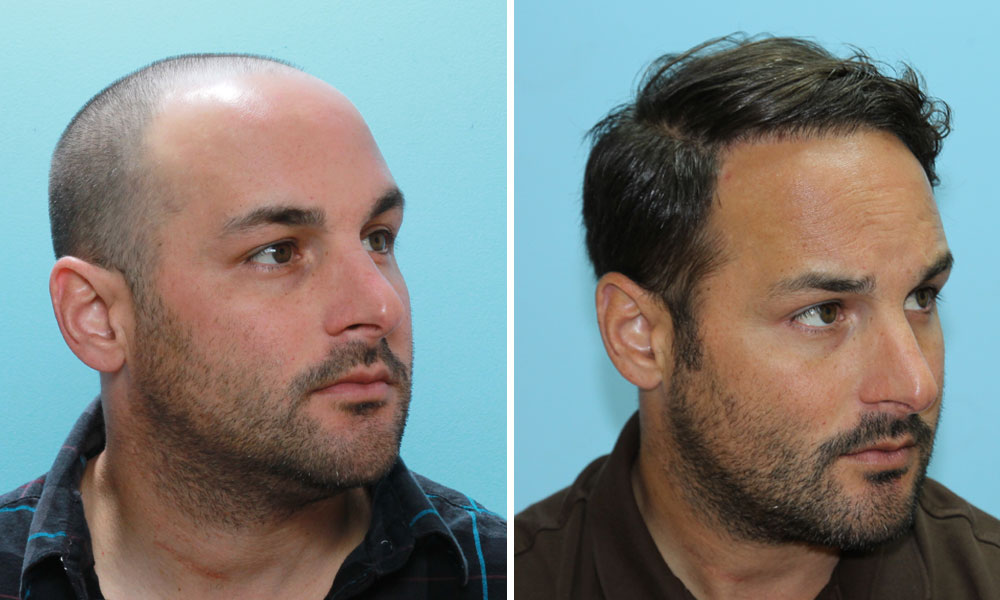 Hair Transplant