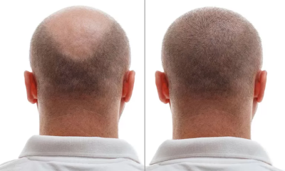 Hair Transplant