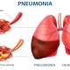 7 More Pneumonia Deaths Reported In Punjab In 24 hours.