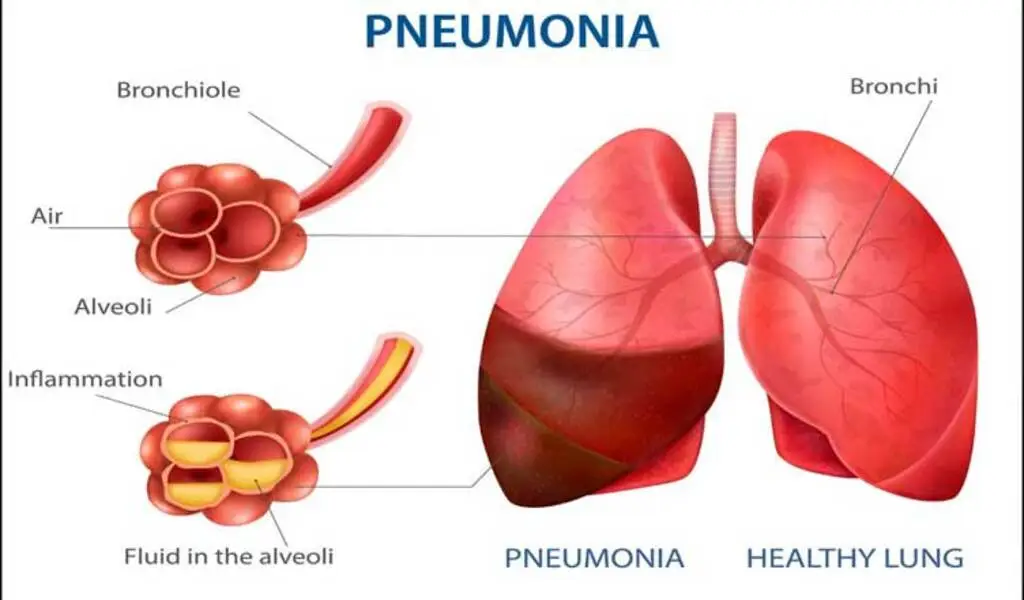 7 More Pneumonia Deaths Reported In Punjab In 24 hours.