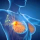 Breast Cancer Exams Rarely Detect Second Cancers After DCIS