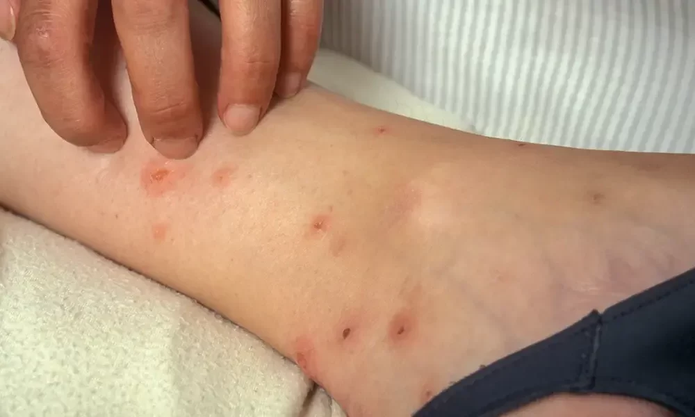 Bed Bug Bites Treatment Learn How To Get Rid Of Itchy Bed Bug Bites