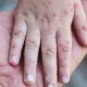 Measles Resurgence In The US
