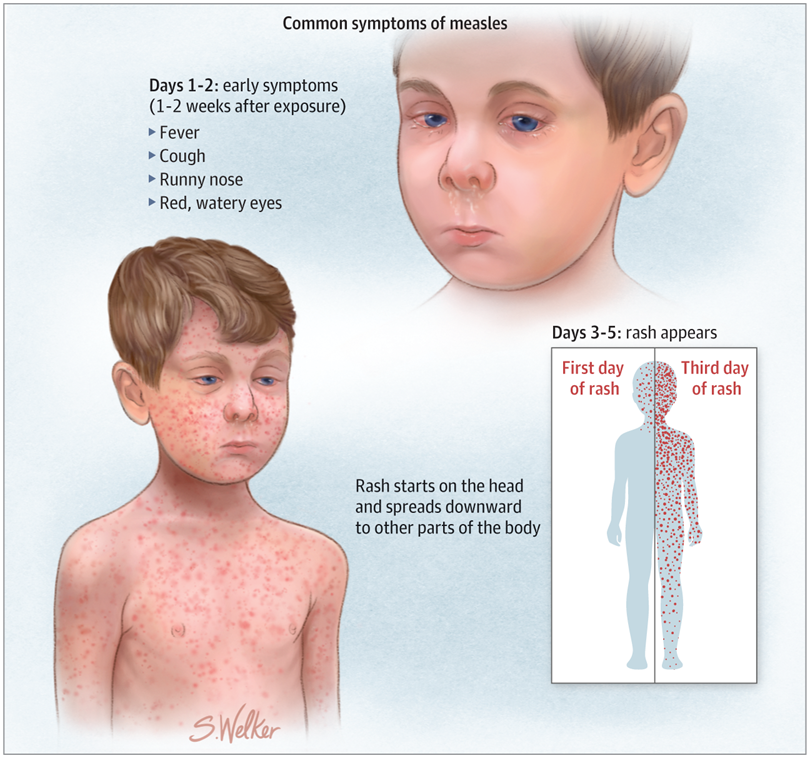 Measles Resurgence In The US1