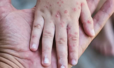 Measles Outbreaks Surge Across the US Causes, Risks, and Vaccination Concerns