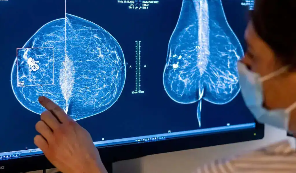 Breast Cancer Treatment Is Delayed By One-Third Of Young Women