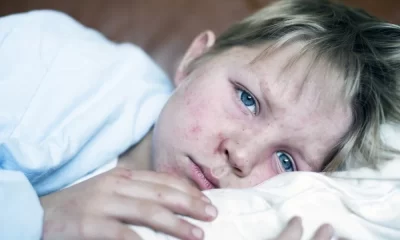 Measles Cases Rise Across Europe, WHO and UNICEF issue Warning