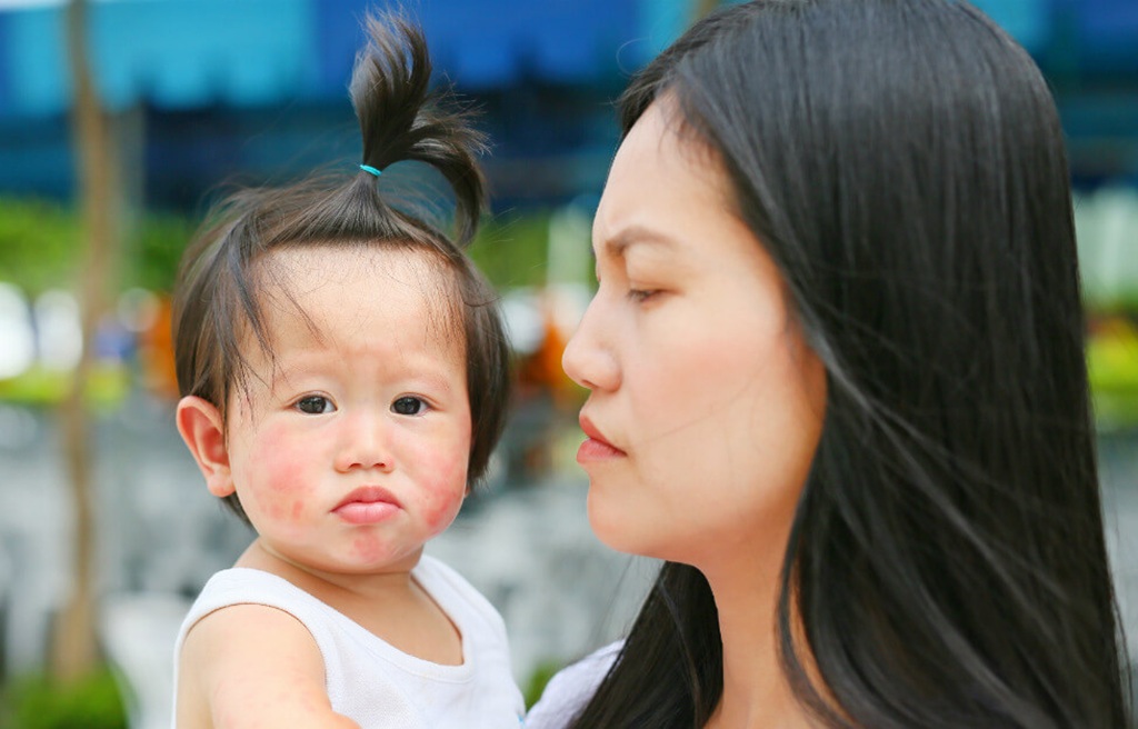 Scarlet Fever in Children thailand