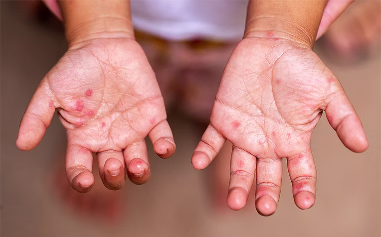 The Department of Disease Control has confirmed the country is facing an outbreak of hand, foot and mouth disease (HFMD),