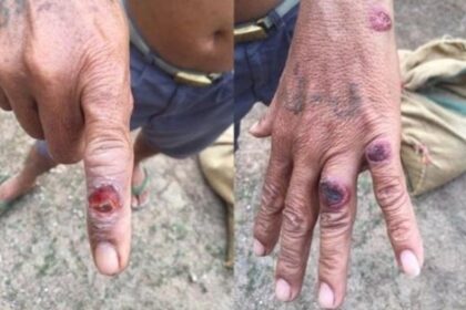 Thailand's DDC Reports New Case of Anthrax in Eastern Thailand