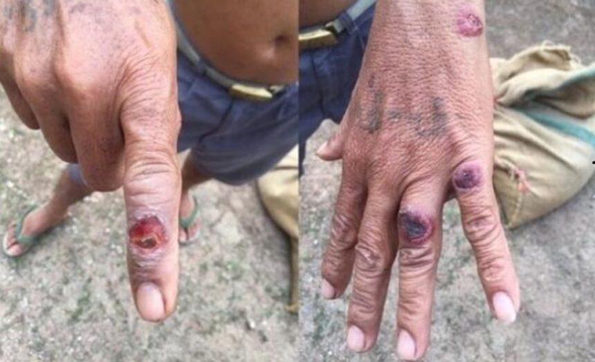 Thailand's DDC Reports New Case of Anthrax in Eastern Thailand