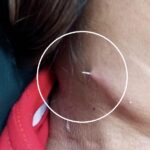 Fish bone pierces womans neck