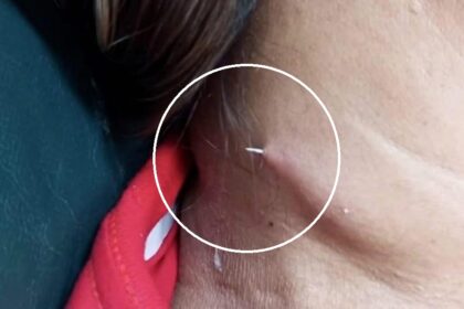 Fish bone pierces womans neck