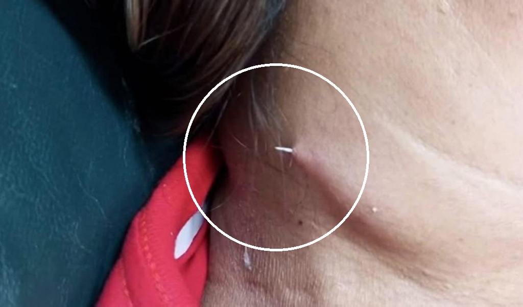 Fish bone pierces womans neck