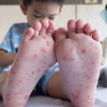 hand, foot, and mouth disease (HFMD)