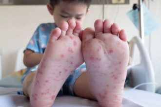 hand, foot, and mouth disease (HFMD)