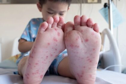 hand, foot, and mouth disease (HFMD)