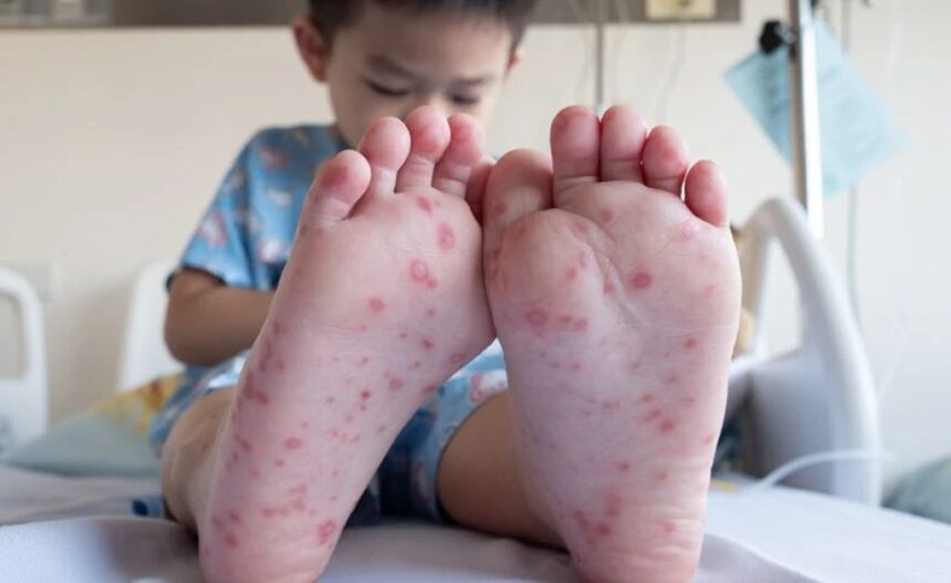 hand, foot, and mouth disease (HFMD)