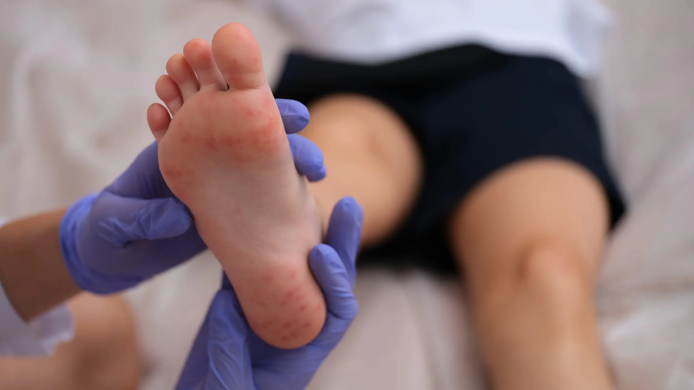 HFMD treatment