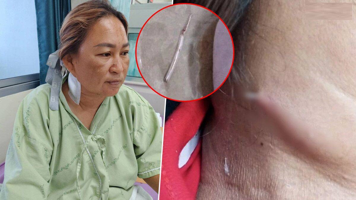 Fish bone pierces womans neck