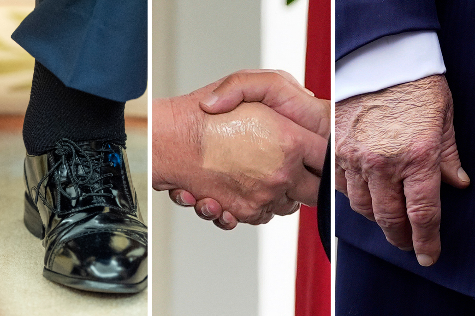 bruised right hand and swollen ankles trump