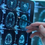 Alzheimer