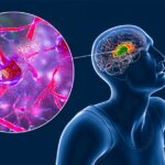 Huntington’s Disease Successfully Treated