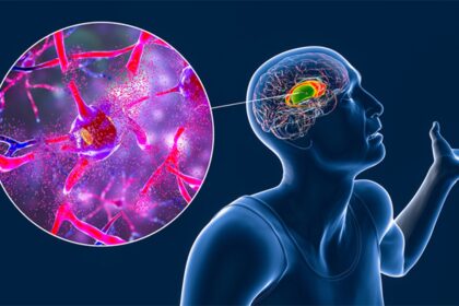 Huntington’s Disease Successfully Treated